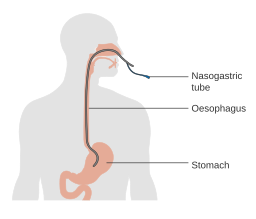 This illustration depicts a nasogastric tube running through the nose, down the esophagus, into the stomach.